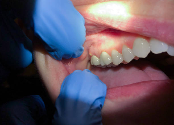 Best Emergency Wisdom Tooth Extraction in Plafield, IN