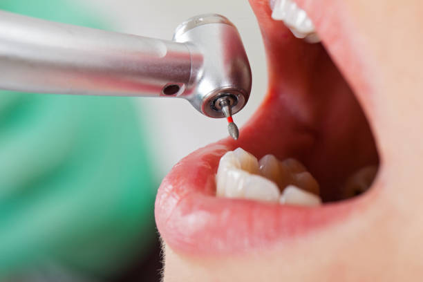 Best Lost Filling or Crown Replacement in Plafield, IN